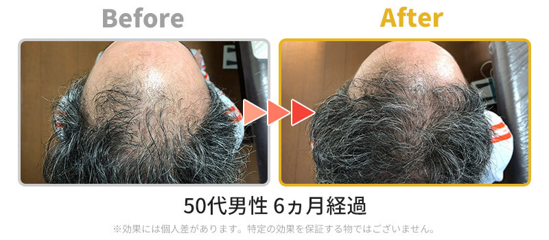 発毛ビフォーアフター6